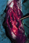 Sutured Tendon